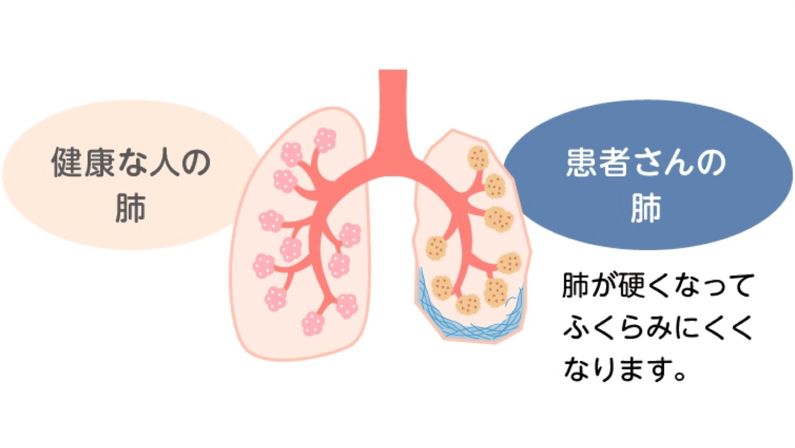 【中古】 リウマチは酸素が治す もはやリウマチは難病ではなくなった/六燿会/井上静雄 Amazon.co.jp: リウマチが治った 寛解症例続々！！ eBook : 篠原