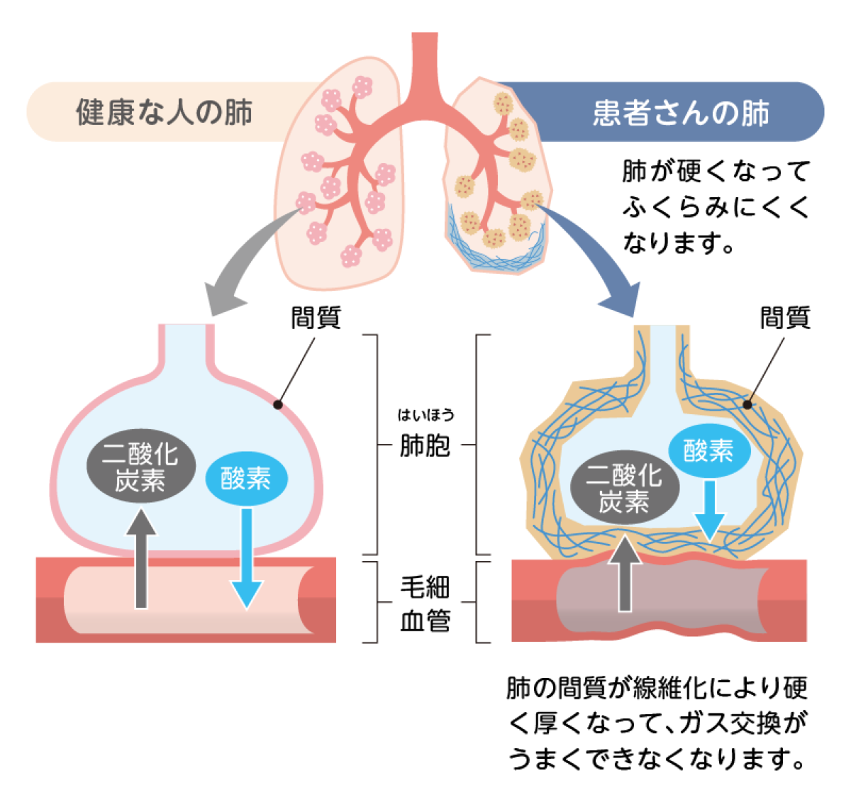 病気が起こるしくみは？ | わかる、つながる、肺線維症