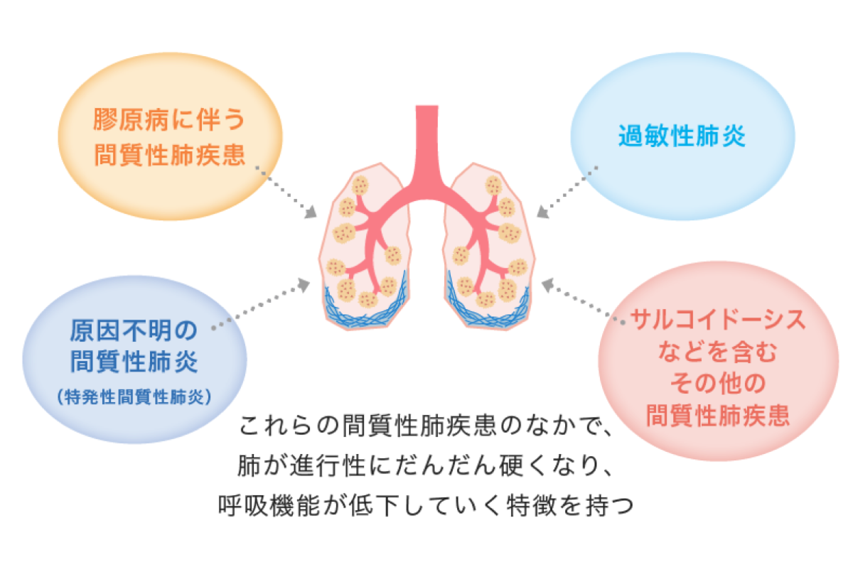 間質性肺疾患はどんな病気なの？ わかる、つながる、肺線維症