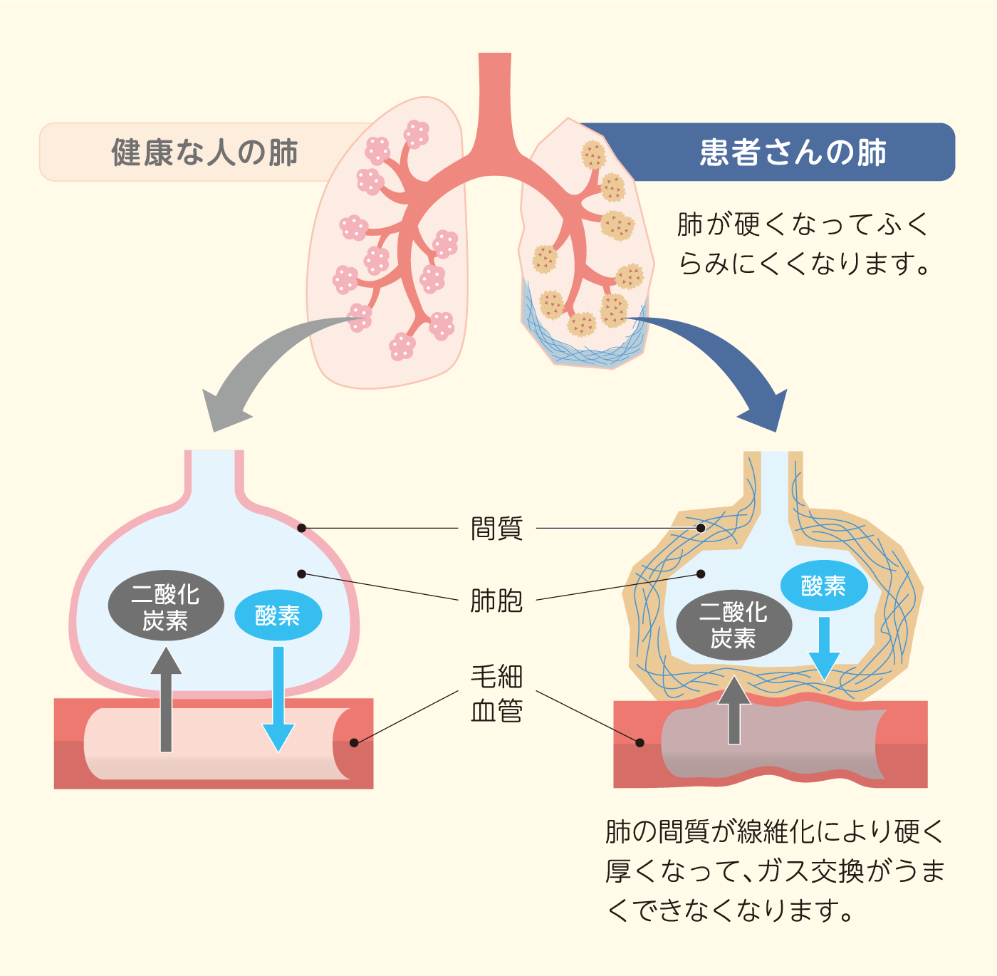 病気の特徴|治療目標とオフェブの働き|PFILD|患者さん・ご家族向け