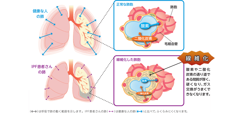 IPF（特発性肺線維症）ってどんな病気？ | わかる、つながる、IPF