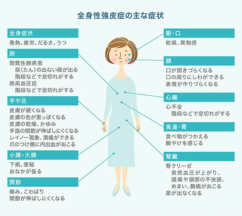 どんな症状が出るの？ | わかる、つながる、強皮症